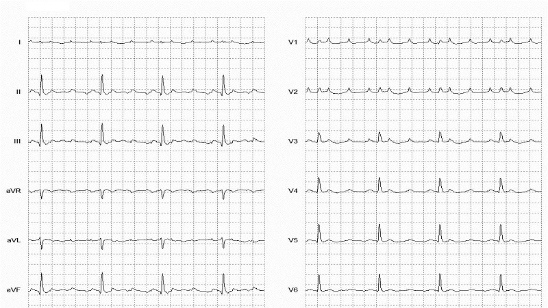 Atrial Flutter 12 Lead EKG